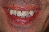 parodontopatia, piorrea